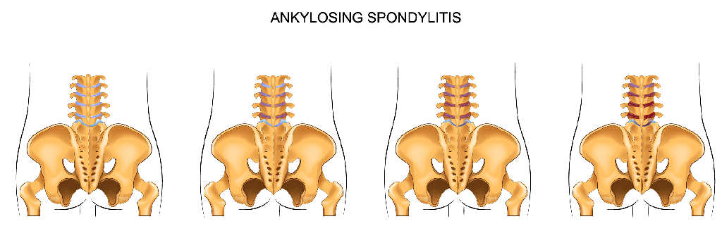 ankylosing spondylitis