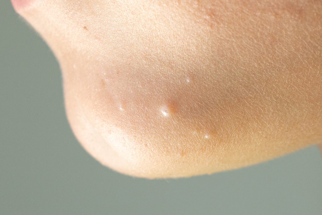 molluscum contagiosum on the chin