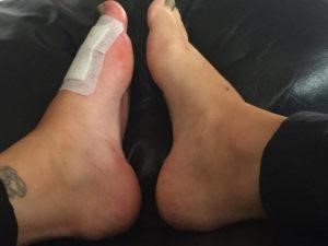 rheumatoid arthritis on woman's feet
