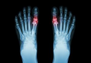 feet rheumatoid arthritis xray