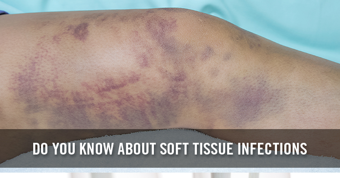 soft tissue infections