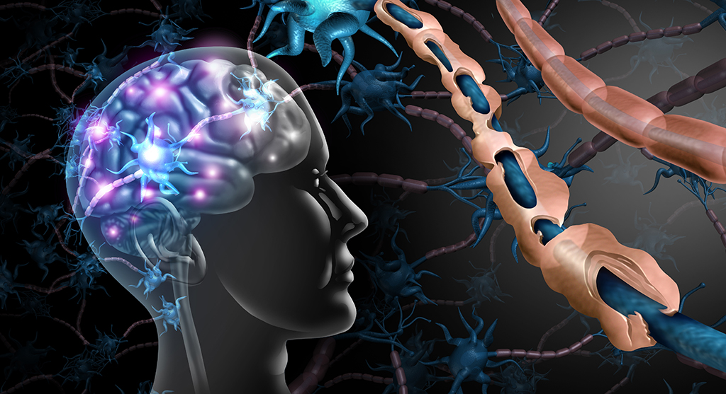 multiple sclerosis in brain